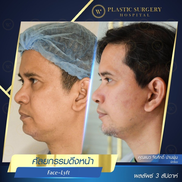 ดึงหน้า