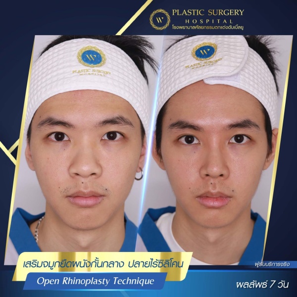 เสริมจมูก