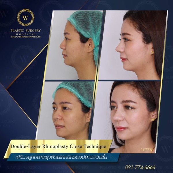 เสริมจมูก