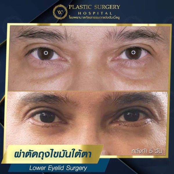 ตัดถุงไขมันใต้ตา