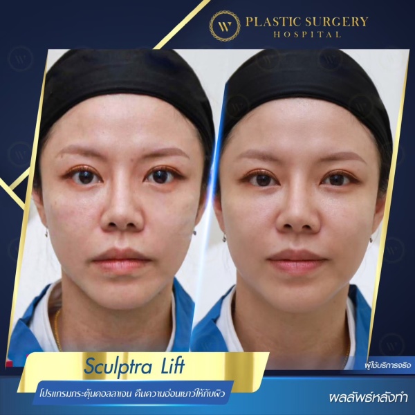 Sculptra Lift