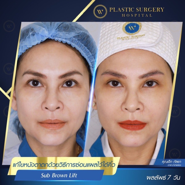 ศัลยกรรมแก้ไขปัญหาหนังตา