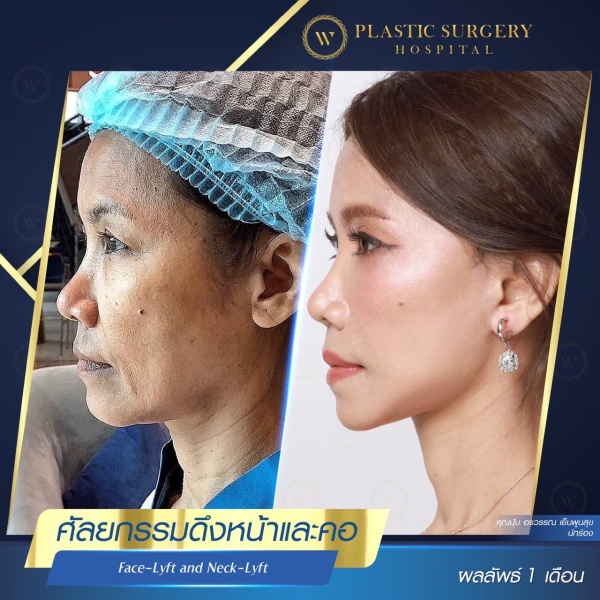 ดึงหน้า