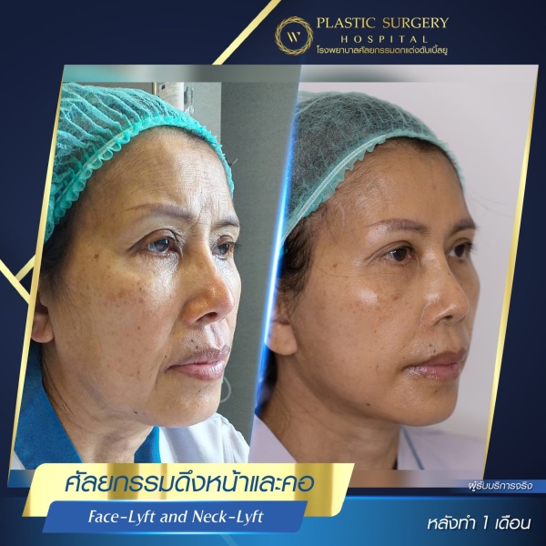 ดึงหน้า