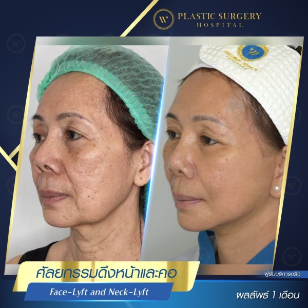 ดึงหน้า