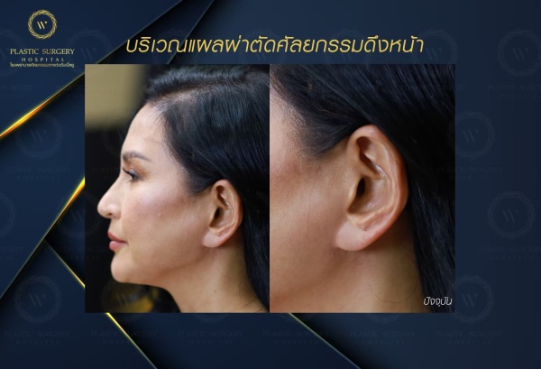 ดึงหน้า