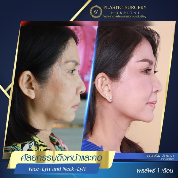 ดึงหน้า