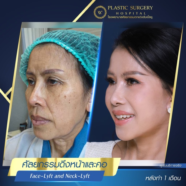 ดึงหน้า