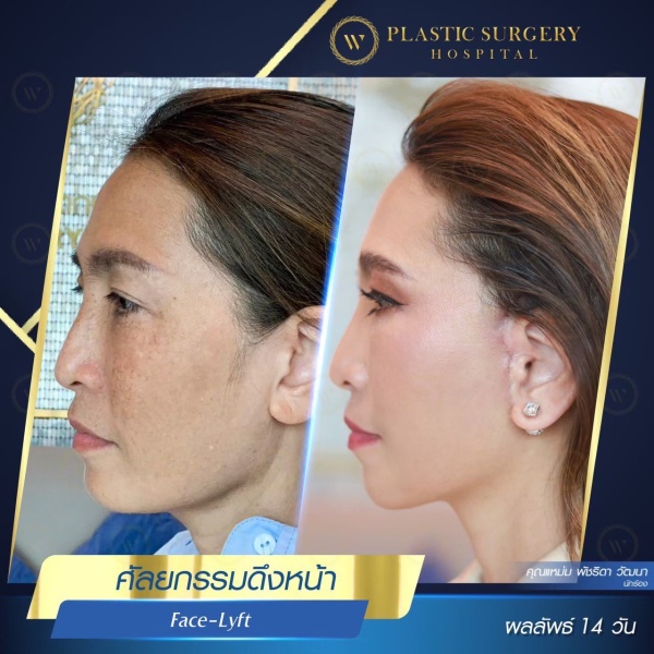 ดึงหน้า