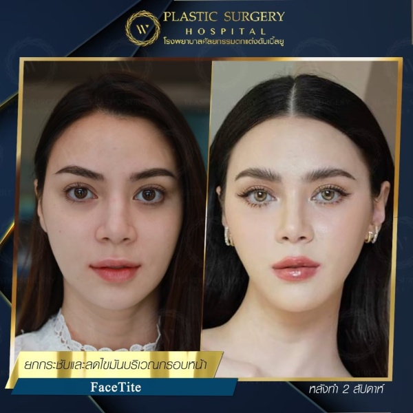ดูดไขมันเหนียงใต้คาง (FaceTite)