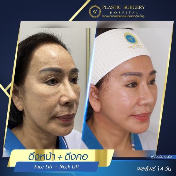 ดึงหน้า