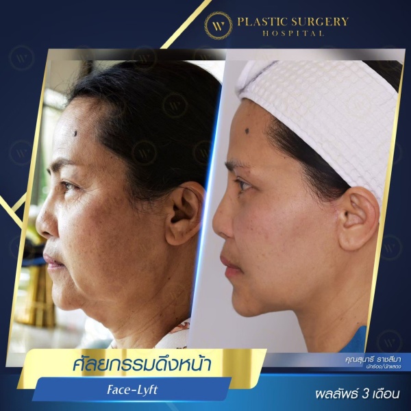 ดึงหน้า