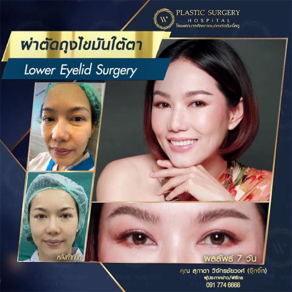 ตัดถุงไขมันใต้ตา