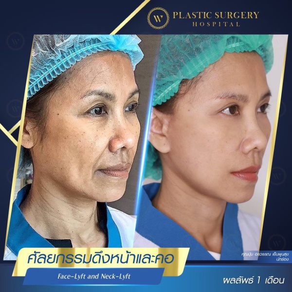 ดึงหน้า