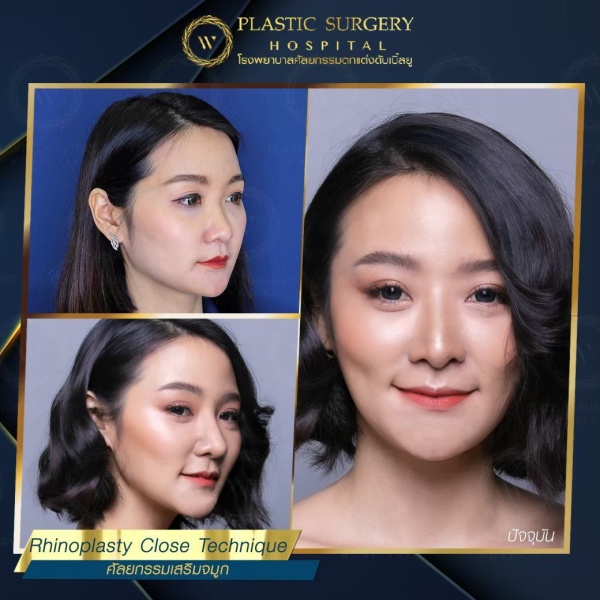 เสริมจมูก