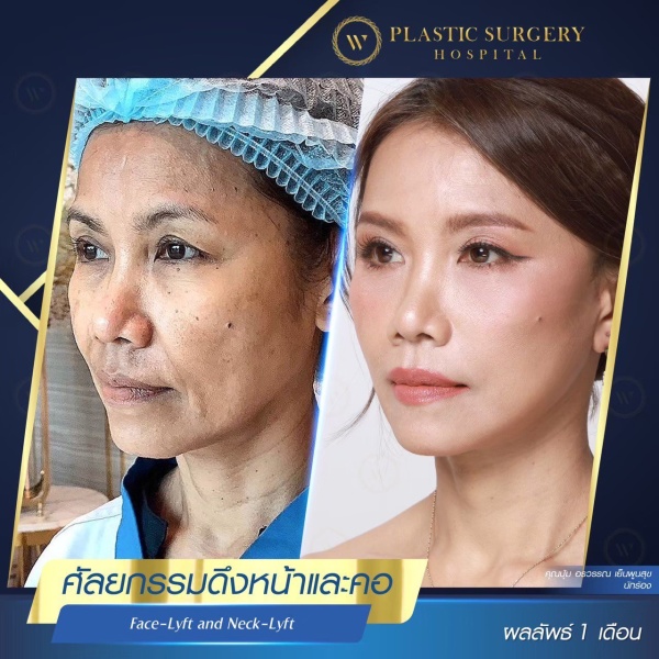 ดึงหน้า