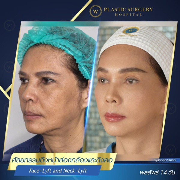 ดึงหน้า