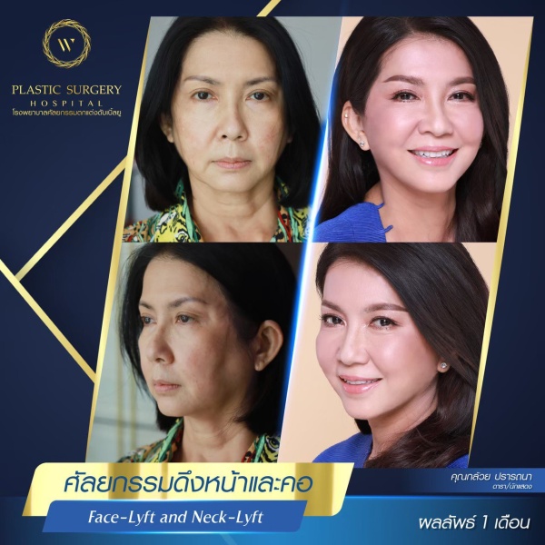 ดึงหน้า