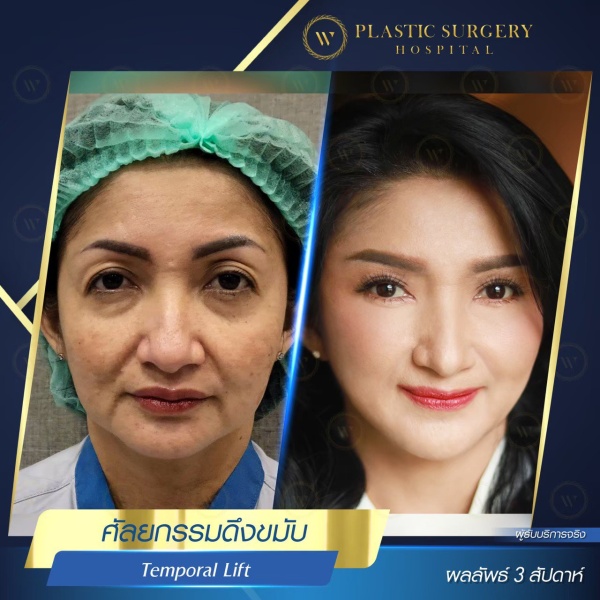 ดึงหน้า