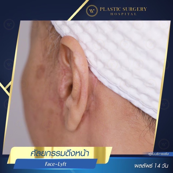 ดึงหน้า