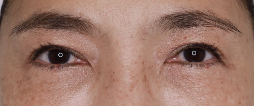 ศัลยกรรมแก้ไขปัญหาหนังตา