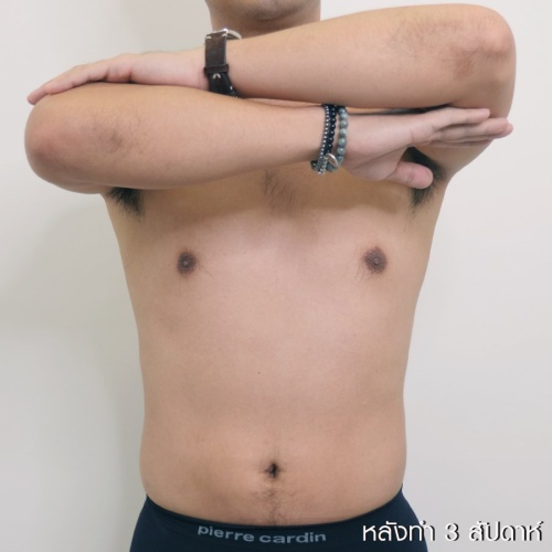 ดูดไขมัน