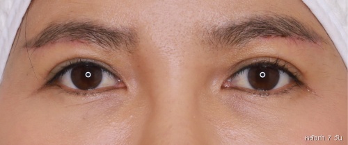 ศัลยกรรมแก้ไขปัญหาหนังตา