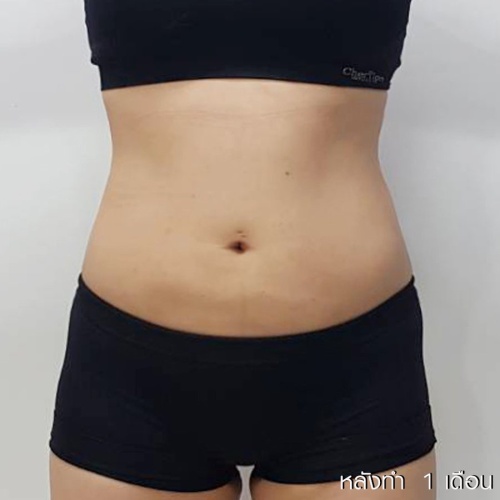 ดูดไขมัน