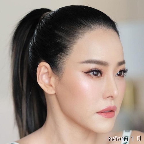 脸部和颈部的提升和抽脂