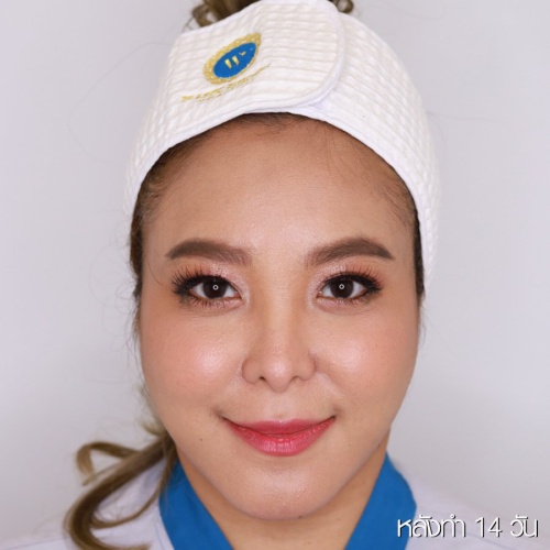 脸部和颈部的提升和抽脂