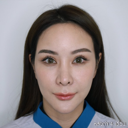 脸部和颈部的提升和抽脂