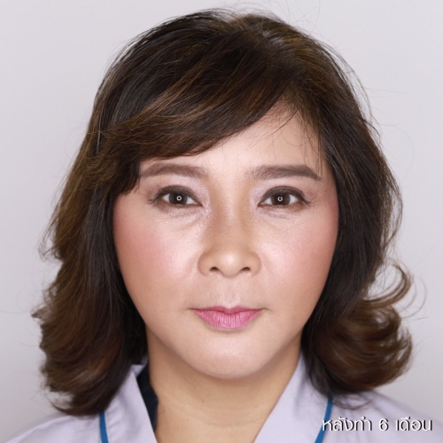 脸部和颈部的提升和抽脂