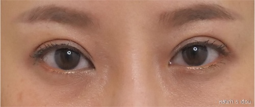 ศัลยกรรมแก้ไขปัญหาหนังตา