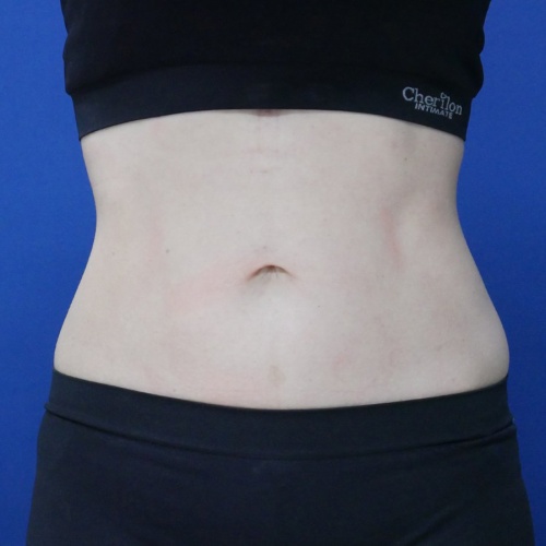 ดูดไขมัน