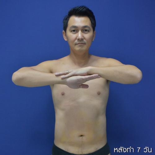 ดูดไขมัน