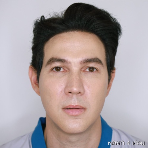 脸部和颈部的提升和抽脂