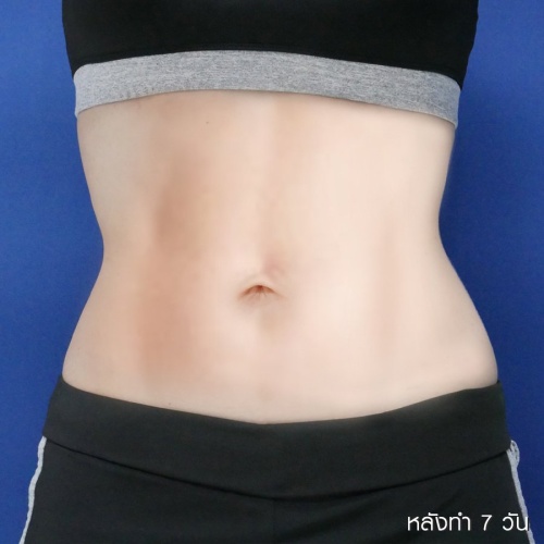 ดูดไขมัน