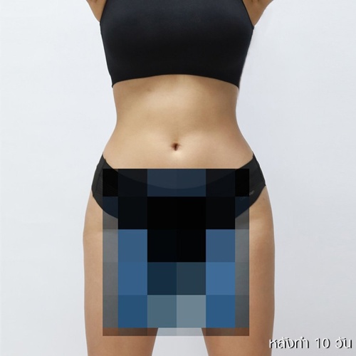 ดูดไขมัน