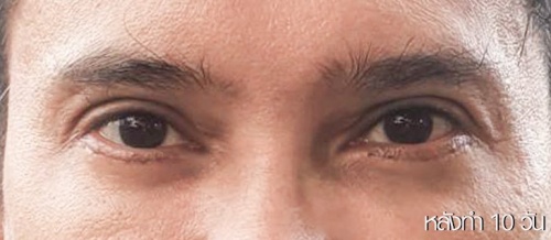 شد الجفن السفلي