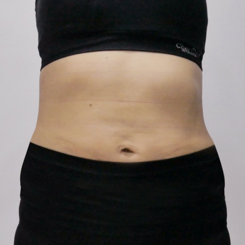 ดูดไขมัน