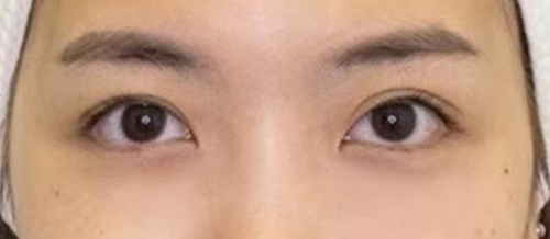 شد الجفن العلوي