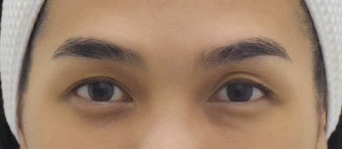 شد الجفن العلوي