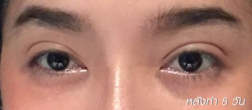 شد الجفن العلوي