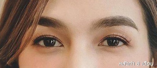 شد الجفن العلوي