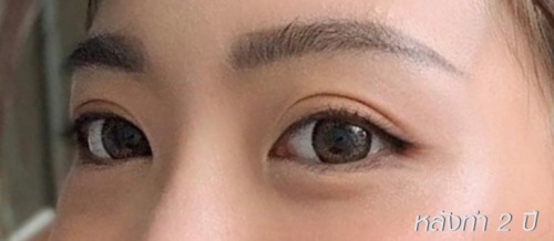 شد الجفن العلوي