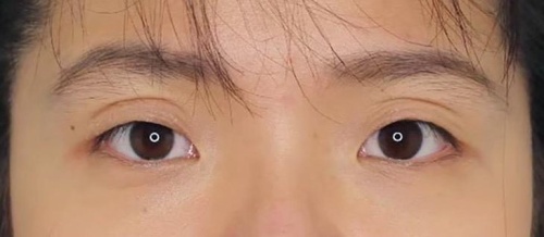 شد الجفن العلوي