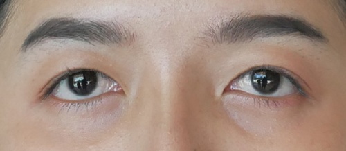 شد الجفن العلوي