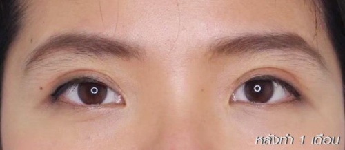 شد الجفن العلوي