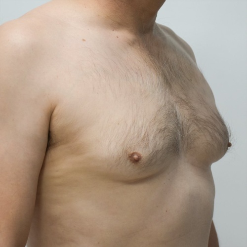 ลดขนาดหน้าอกผู้ชาย